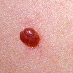 Example of skinLumpsAndBumps